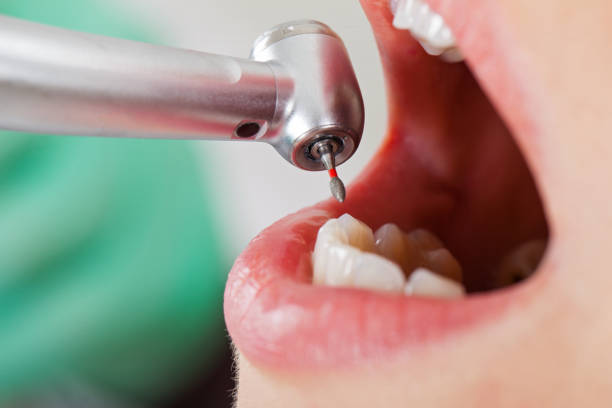 Best Dentist for Tooth Abscess  in Silt, CO